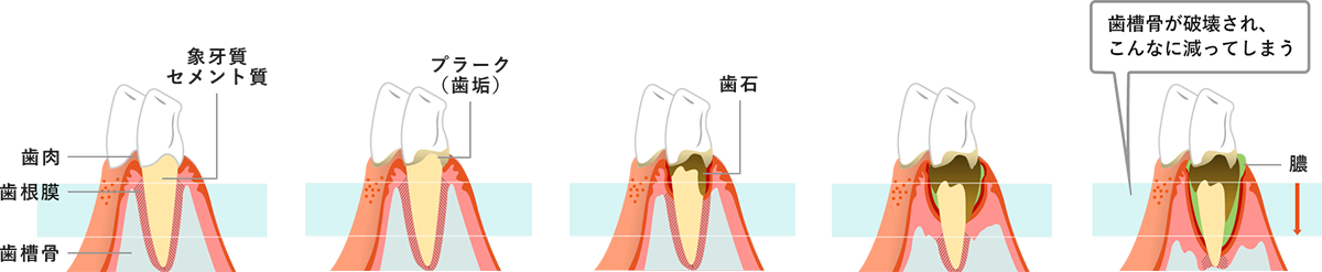 歯周病の原因