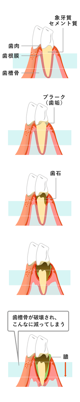 歯周病の原因